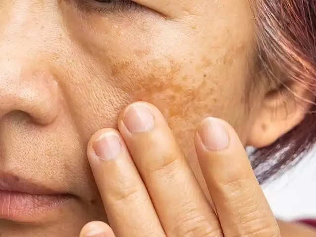 Know About Hyperpigmentation & Melasma Treatment Cure