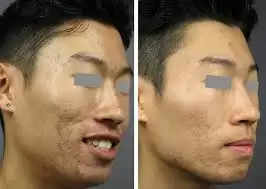 face scar