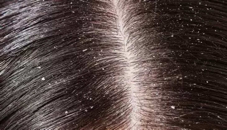 Dandruff