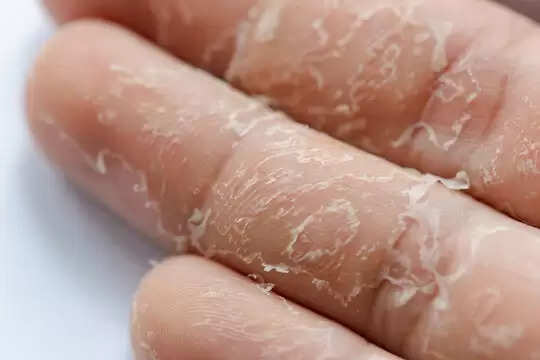 Top 5 Home Remedies To Get Cure Palm Skin Peeling