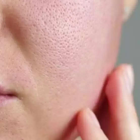 Open pores