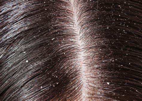 Best Ayurvedic Products To Cure Dandruff