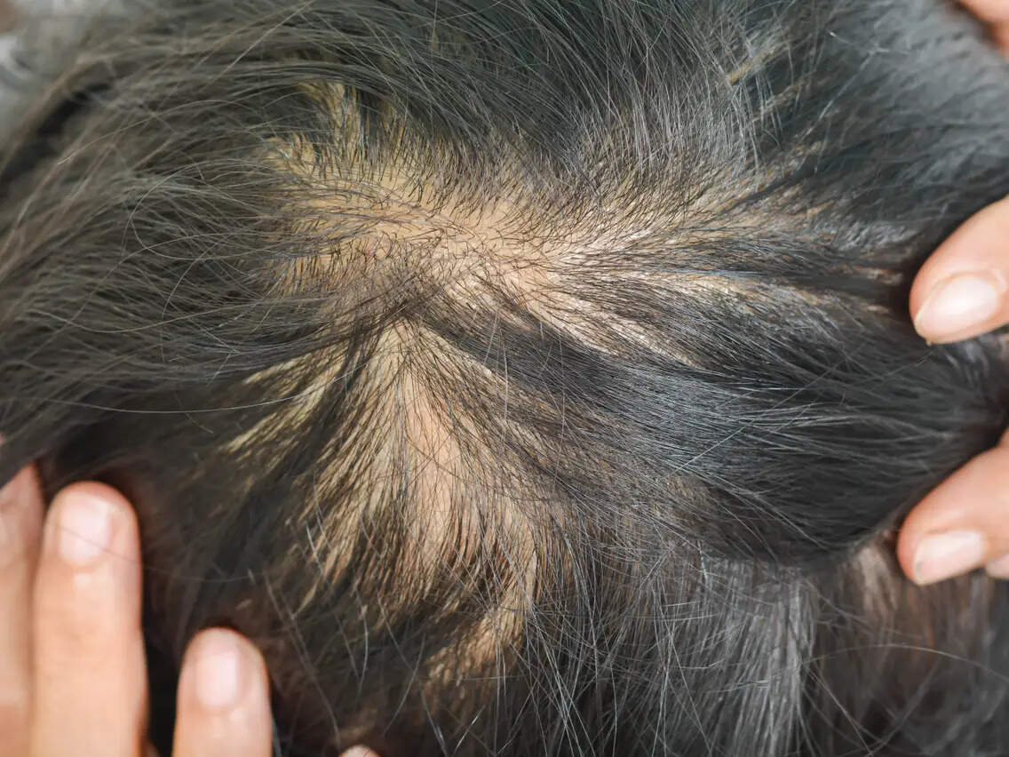 Top 7 Shampoo Mistakes Which May Result In Hair Loss & Scalp Issues
