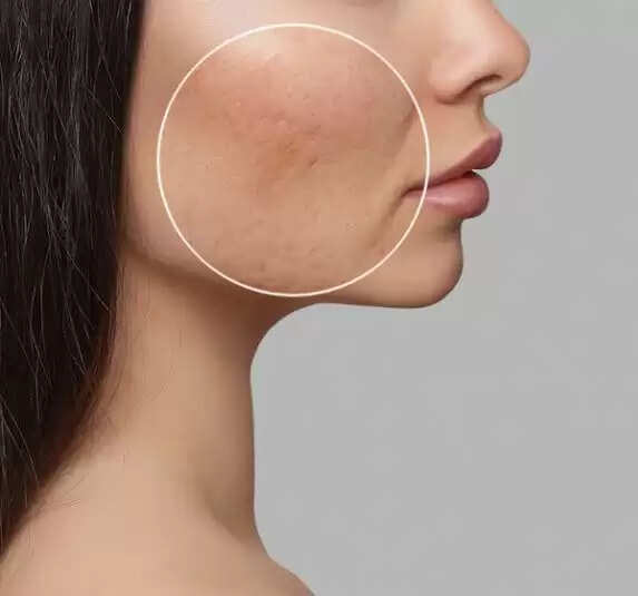 Know About Open Pores, Ageing Skin Correlation Treatment