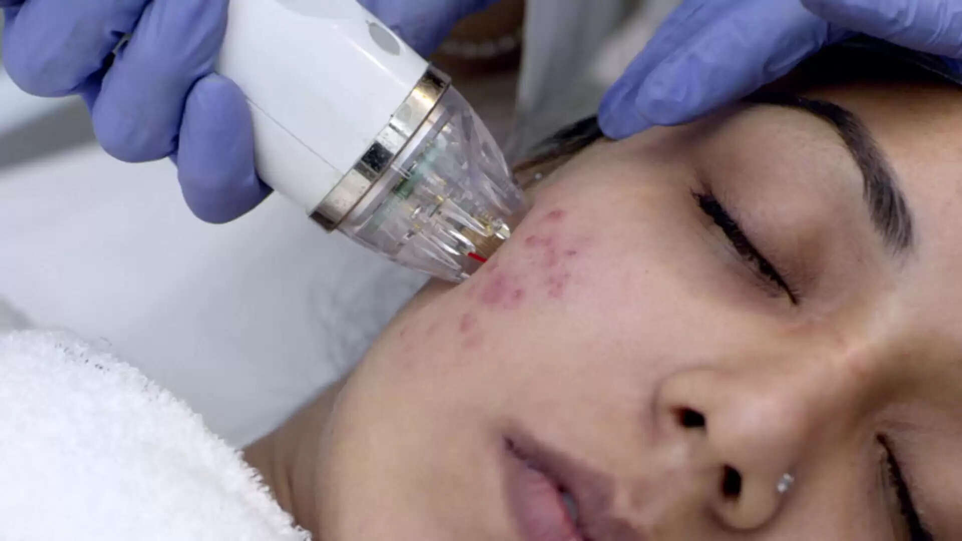 Known About The Best Face Scar Treatment in Mumbai (Acne Scar)