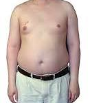 Klinefelter Syndrome