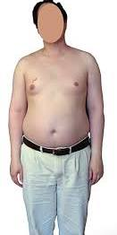 Klinefelter Syndrome