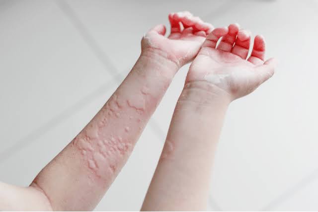 Skin Allergy